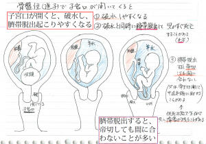 04 妊娠後期 骨盤位 逆子 の前期破水と臍帯脱出 飯能産婦人科 医学情報