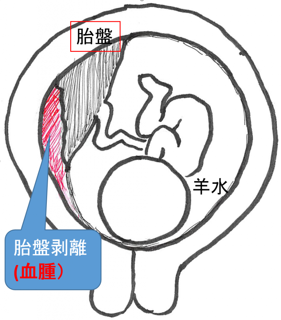 04】妊娠後期: ₀₃₎胎盤早期剥離の症状、あったら、すぐ来院 【飯能産婦人科】,医学情報 04】妊娠後期: ₀₃₎胎盤早期剥離の症状、あったら、すぐ来院 【飯能産婦人科】,医学情報