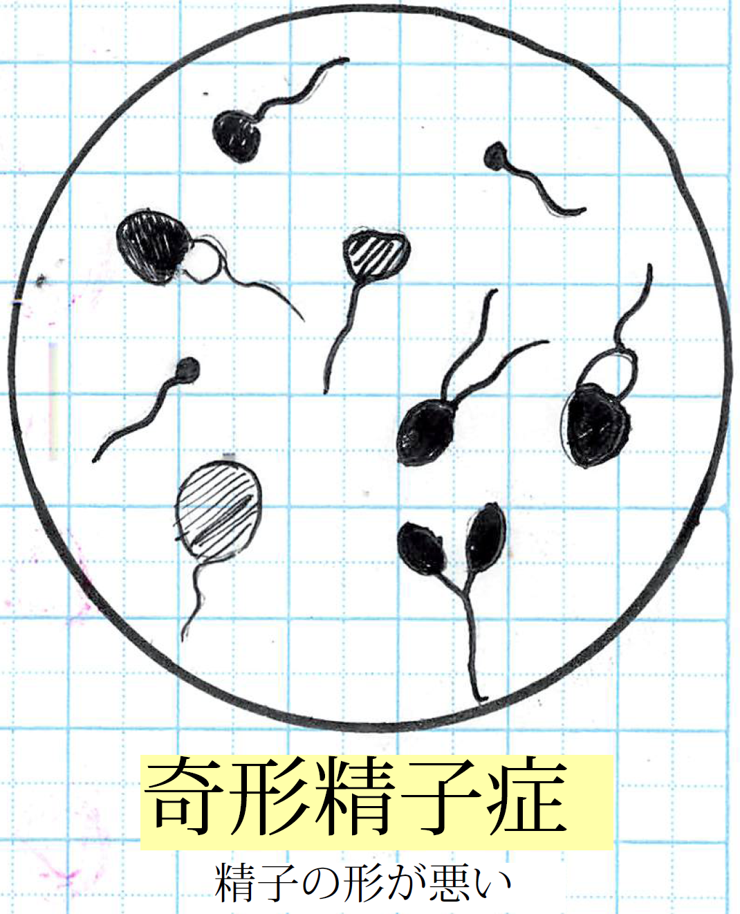 60】不妊： ₀₈₎精液検査、精液検査不良の方の対策 【飯能産婦人科】,医学情報