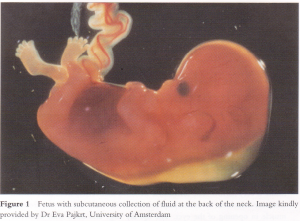 02 妊娠初期 胎児の頸部浮腫 Nt 妊娠11 13週でcheck 飯能産婦人科 医学情報